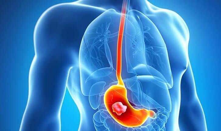 If you suffer from a stomach ulcer, following the Dukan diet is contraindicated.